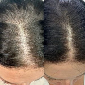 Hair Restoration Before and After Results