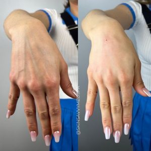 Hand Filler Before and After