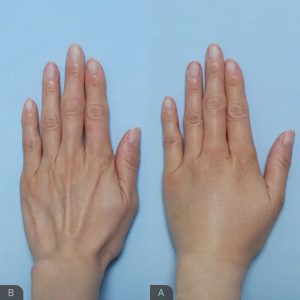 Hand Filler Results Before and After