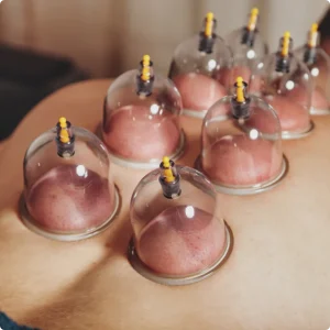 Hijama Cupping Therapy