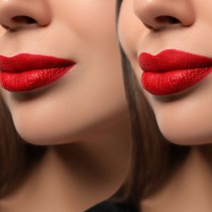 Lip filler treatment