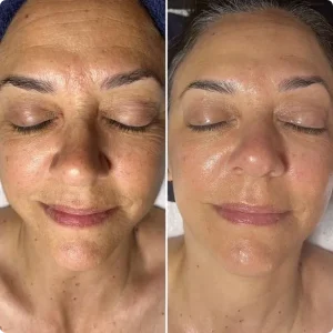 Mesotherapy treatment before and after
