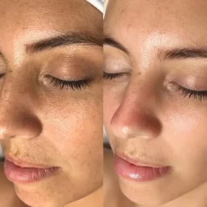 Mesotherapy treatment before and after
