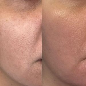 Microneedling before and after for acne scars