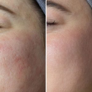 Microneedling before and after for acne scars