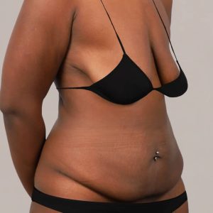 Mommy Makeover Before and After Results