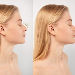 Nasal bridge and tip refinement with rhinoplasty
