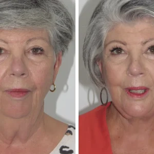 Neck Lift Before & After