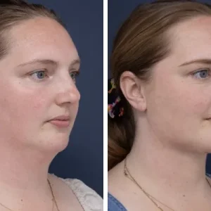 Neck Lift Results