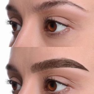 Non-Surgical Brow Lift Before After