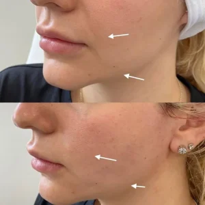 Non-Surgical Facelift before and after Thread Lift