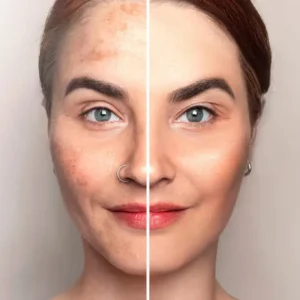 Non-invasive laser facial