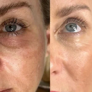 PRF Injection before and after showing improved skin tone