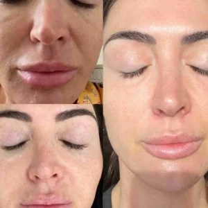 PRF Injection before and after showing improved skin tone