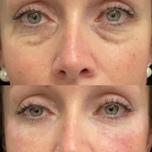 PRF Under Eye Rejuvenation Before and After Results