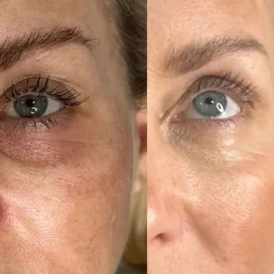 PRF Under Eye Rejuvenation Before and After Results