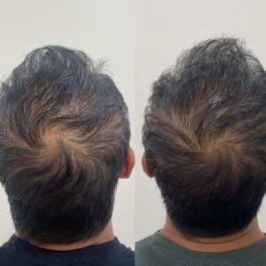 PRP Hair Treatment before and after for hair thinning