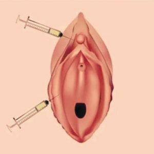 PRP Treatment for Intimate Wellness
