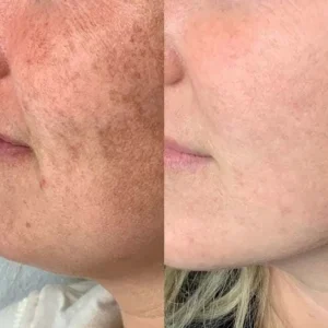 Pigmentation reduction before and after treatment