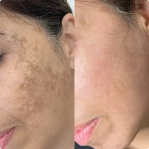 Pigmentation reduction before and after treatment