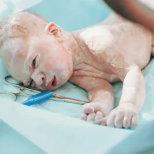 Repeat Cesarean Section