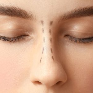 Rhinoplasty-In-Dubai