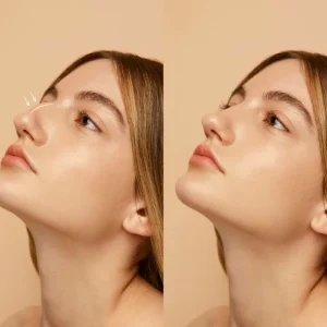 Rhinoplasty before and after comparison