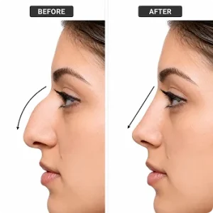 Rhinoplasty