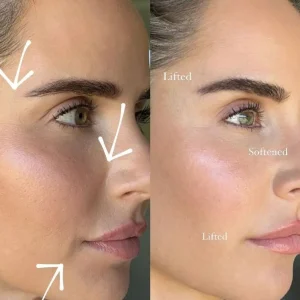 Thread Lift before and after treatment in Dubai