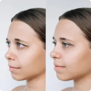 Upper Eyelid Blepharoplasty before and after