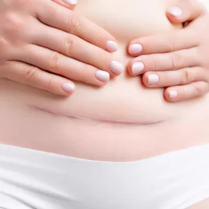 What Is a Cesarean Scar Assessment