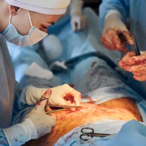 What Is a Repeat Cesarean Section
