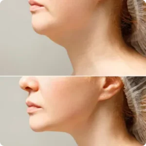 before after surgery