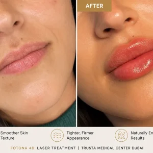 fuller lips after treatment results