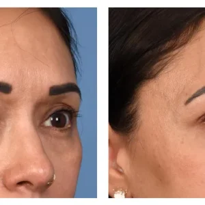 blepharochalasis treatment