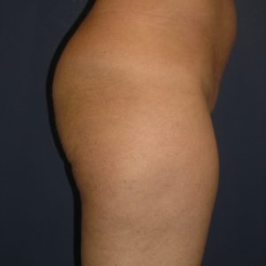 brazilian butt lift before and after Results