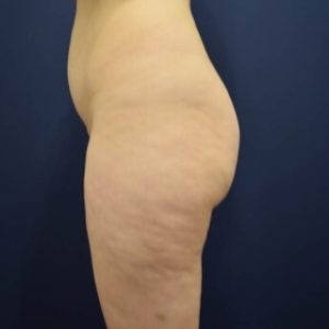 brazilian butt lift before and after