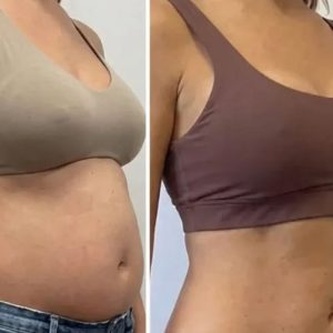 breast augmentation before after