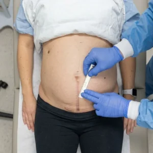 c-section scar release therapy