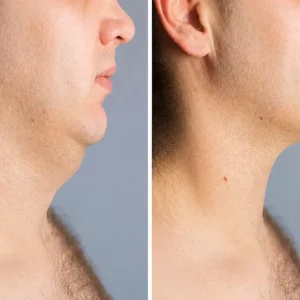Double chin liposuction treatment for jawline contouring
