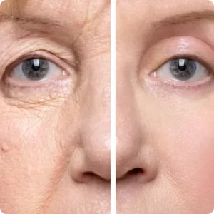eyelid surgery