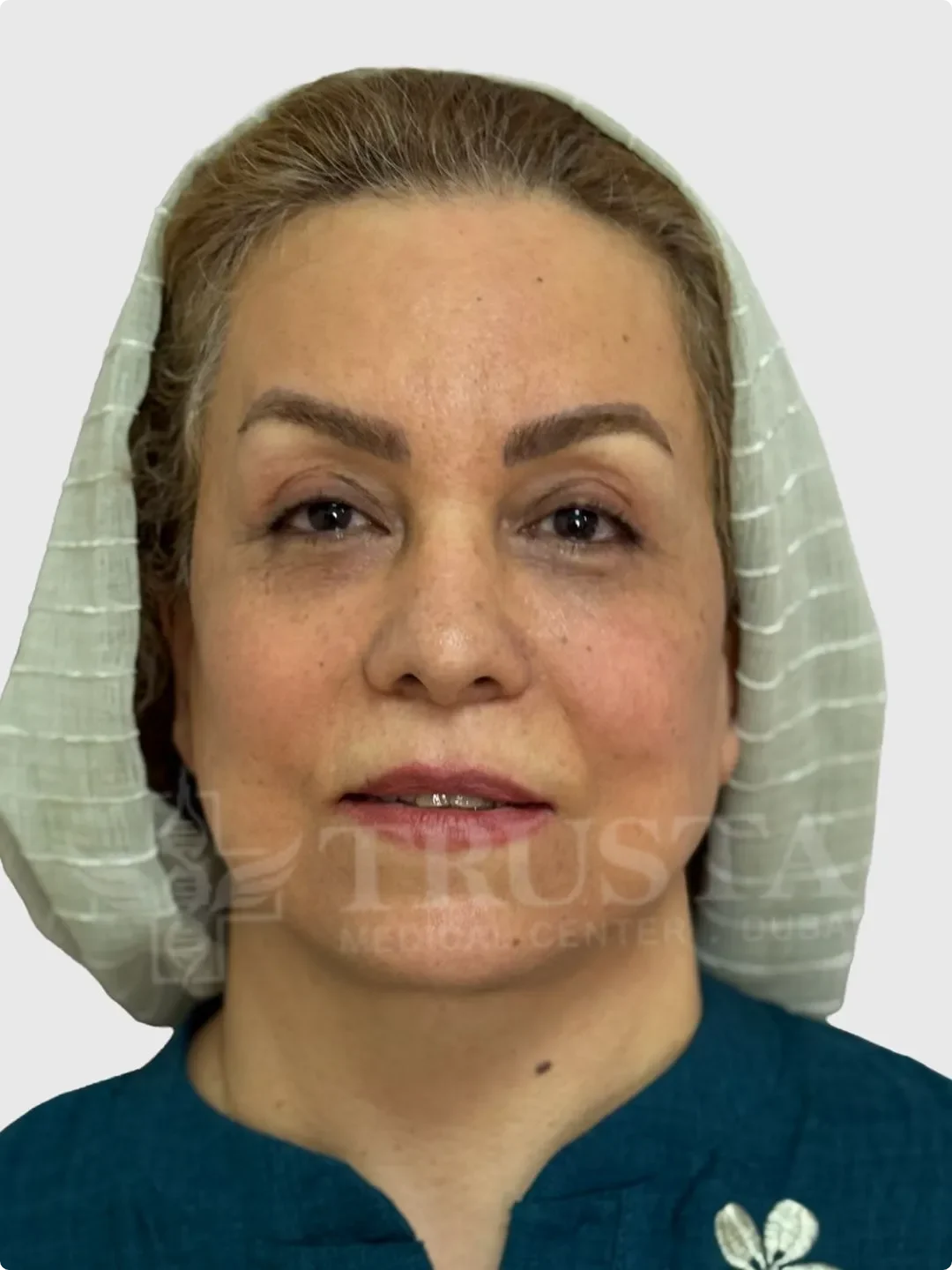 facelift After