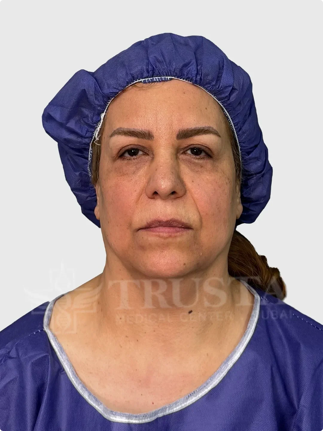 facelift Before