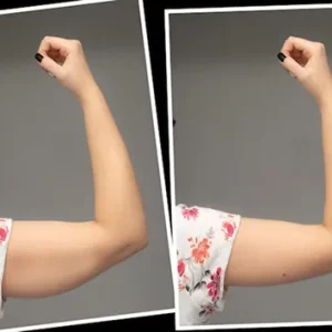 liposuction cost
