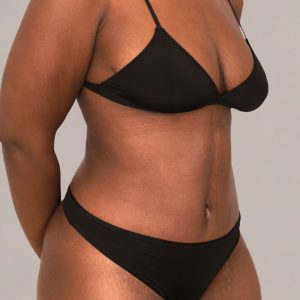 mommy makeover surgery before after