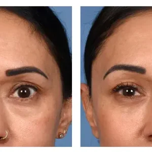 surgical eye bag removal